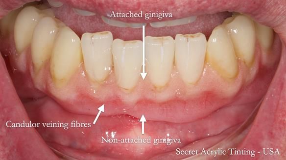 Newsletter 74: Ken’s Case Study Complete Dentures - Life Like and Age Appropriate