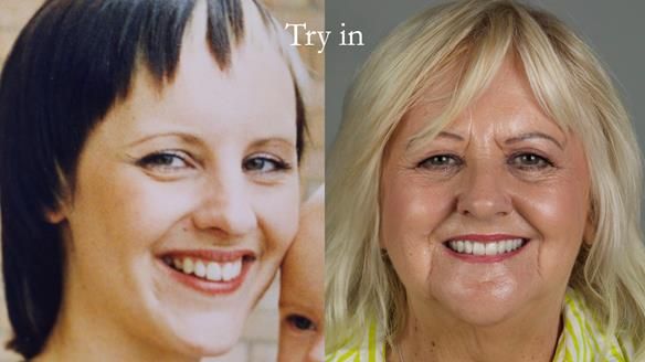 Newsletter 68 Restoring Jan’s Smile: Complete Dentures Inspired by Her Daughter’s Teeth - Post Mouth Surgery