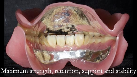 Newsletter 74: Ken’s Case Study Complete Dentures - Life Like and Age Appropriate