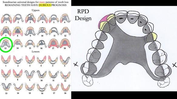 Read Newsletter 67 - Brian's COMBAT DENTURE Case Study