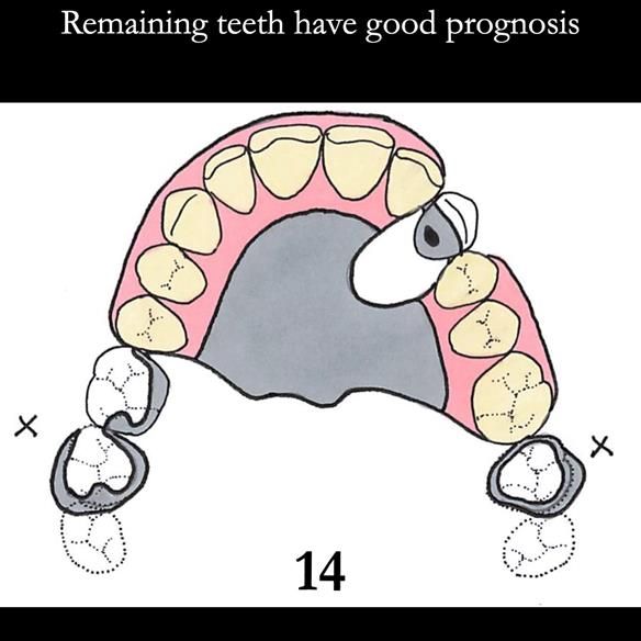 Universal Scandinavian partial denture designs