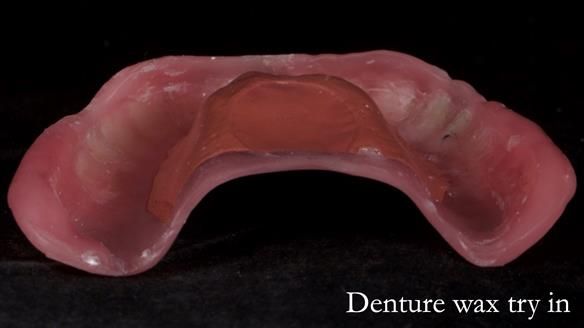 Newsletter 70 Complete Denture Treatment for Kate: A Case Study on Natural-Looking Dentures and Implant-Supported Overdentures