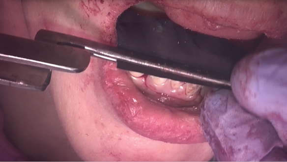 Figure 40 Occlusion checked