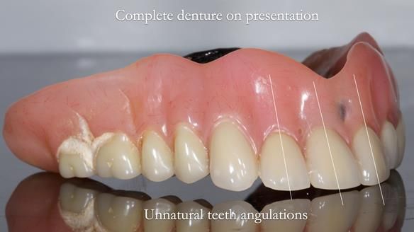 Newsletter 74: Ken’s Case Study Complete Dentures - Life Like and Age Appropriate