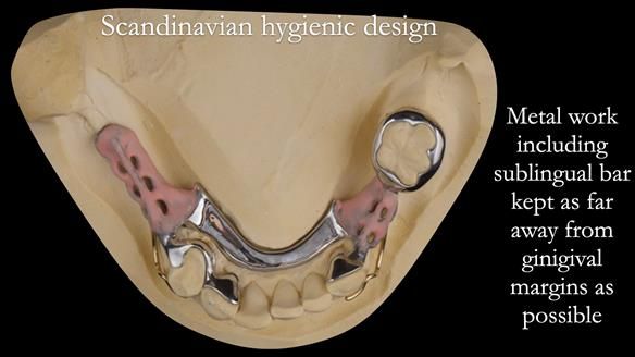 Eileen's transformation with upper and lower RPDs of Scandinavian hygienic design FULL PROTOCOL