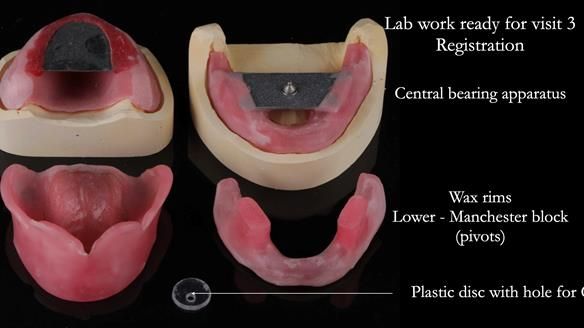 Newsletter 48 Mavis's Complete denture FULL PROTOCOL