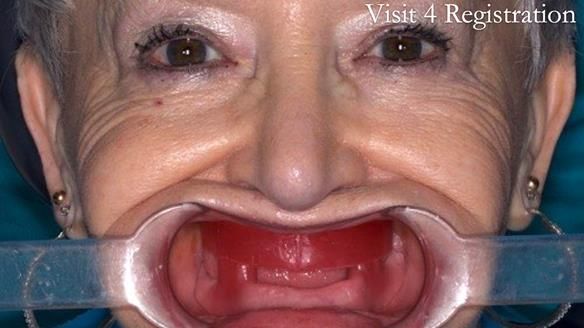 Newsletter 49 Managing Estelle’s failing implants with dentures FULL PROTOCOL