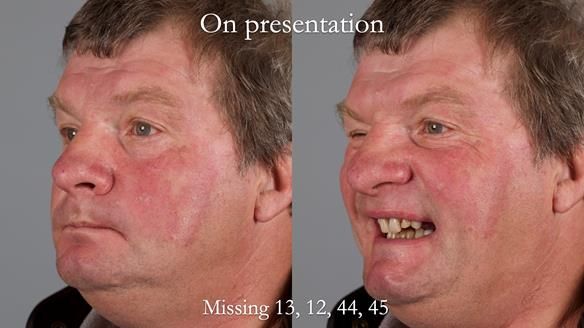 Read Newsletter 67 - Brian's COMBAT DENTURE Case Study