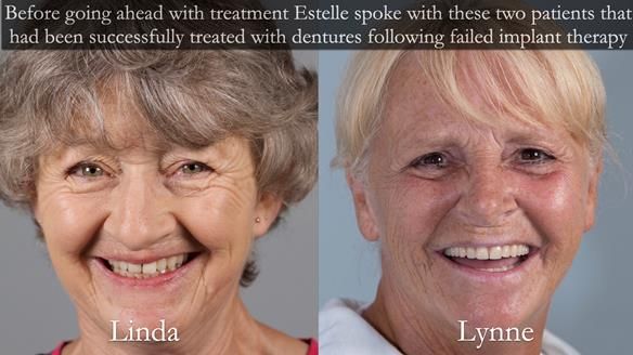 Newsletter 49 Managing Estelle’s failing implants with dentures FULL PROTOCOL