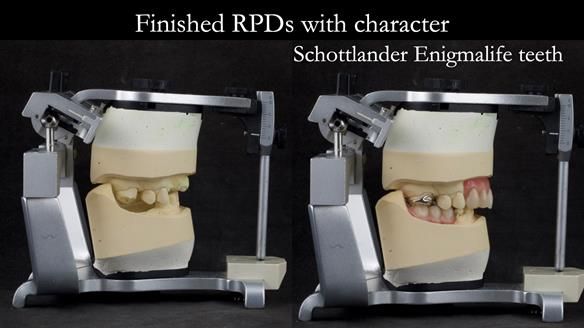 Eileen's transformation with upper and lower RPDs of Scandinavian hygienic design FULL PROTOCOL