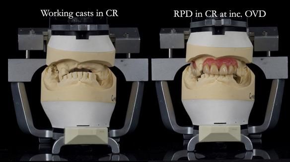 How Keith’s combat denture transformed his life – Newsletter 73