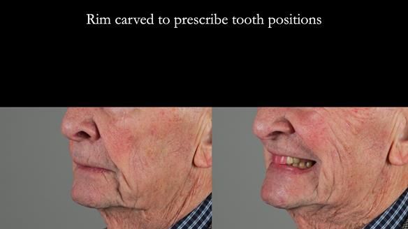 Managing Edgar “THE SCEPTIC” with an RPD/Splint FULL CASE