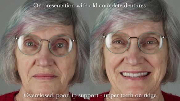 Newsletter 70 Complete Denture Treatment for Kate: A Case Study on Natural-Looking Dentures and Implant-Supported Overdentures