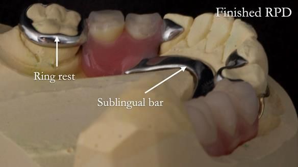 Eileen's transformation with upper and lower RPDs of Scandinavian hygienic design FULL PROTOCOL