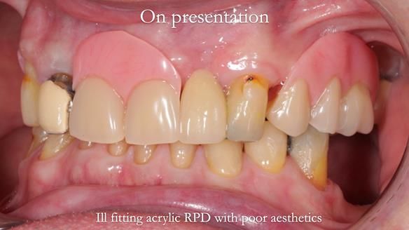 Managing Edgar “THE SCEPTIC” with an RPD/Splint FULL CASE