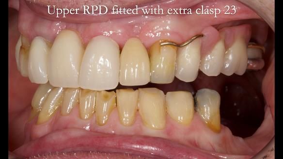 Managing Edgar “THE SCEPTIC” with an RPD/Splint FULL CASE